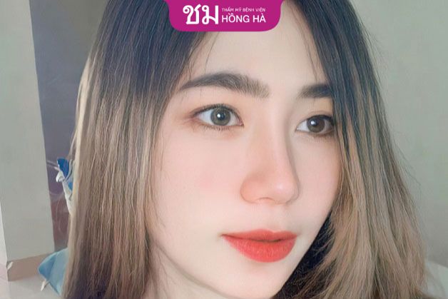 Trường hợp nâng mũi sụn nhân tạo không tương thích cần sử dụng sụn tự thân