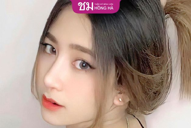 Nâng mũi bằng sụn tai có đau không- Nâng mũi bọc sụn cao