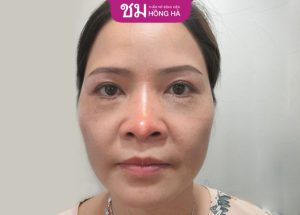 Nâng mũi bao lâu hết sưng – Lưu ý nhanh lành, đẹp