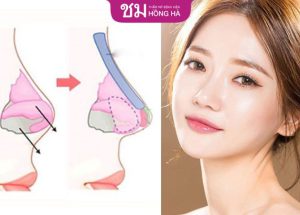 Nâng mũi bọc sụn được bao lâu? Cách duy trì lâu dài