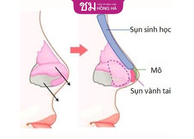 Chất liệu để nâng mũi bọc sụn tai