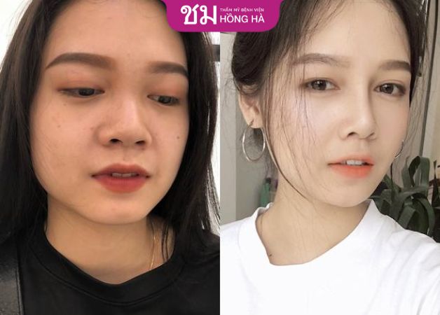 Dáng mũi của khách hàng sau khi nâng mũi 7 ngày