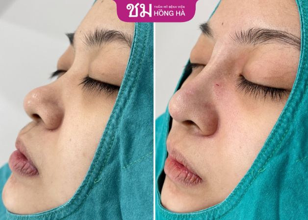 Nâng mũi sụn tai giúp khách hàng sở hữu mũi đẹp lâu dài