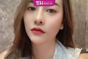 Nâng mũi cấu trúc bao lâu thì đẹp – Bác sĩ thẩm mỹ giải đáp