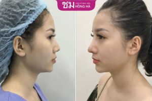 Nâng mũi cấu trúc có bị lệch không – Nguyên nhân khiến mũi lệch