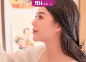 Nâng mũi có cười được không? Bác sĩ Robert Nguyễn trả lời