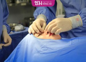 Nâng mũi ergonomic là gì? Khác gì với nâng mũi bình thường? 