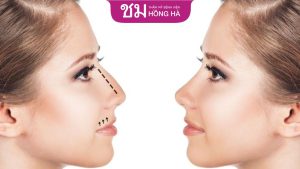 Nâng mũi gồ thẳng, đẹp tự nhiên tại Thẩm mỹ Hồng Hà