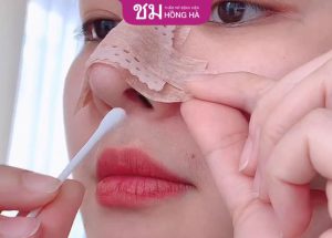 Nâng mũi mấy ngày tháo băng, tháo nẹp mũi