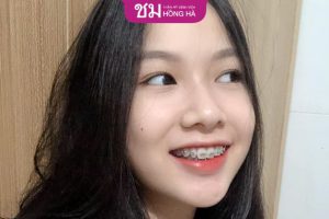 Nâng mũi rồi có niềng răng được không – Lưu ý đặc biệt