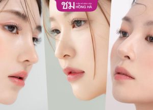 Giải đáp ngay : Nâng mũi rồi có thu nhỏ đầu mũi được không ?