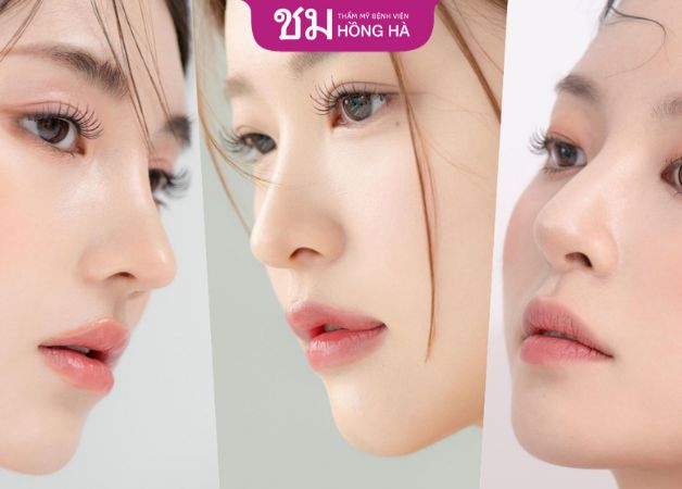 Nâng mũi S line sẽ hồi phục hoàn toàn sau một tháng