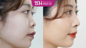 Nâng mũi sụn nhân tạo: 3 sai lầm cần lưu ý khi nâng