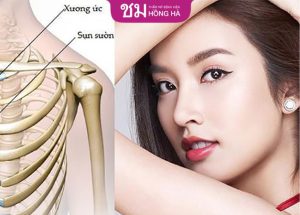 Nâng mũi sụn sườn có vĩnh viễn không – Những điều cần biết