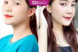 Tìm hiểu cặn kẽ các loại nâng mũi hiện nay trong ngành PTTM