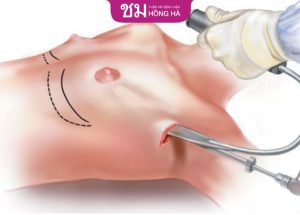 Nâng ngực đường nách tốt không? Phù hợp với ai? 