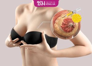 Nâng ngực giữ được bao lâu? 4 Yếu tố ảnh hưởng