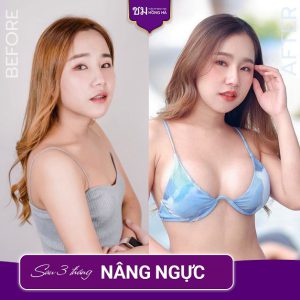 Nâng ngực ở đâu đẹp, uy tín –  Thẩm mỹ Bệnh viện Hồng Hà