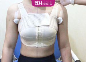 Nâng ngực phải nghỉ dưỡng bao lâu? 4 Yếu tố ảnh hưởng đến thời gian