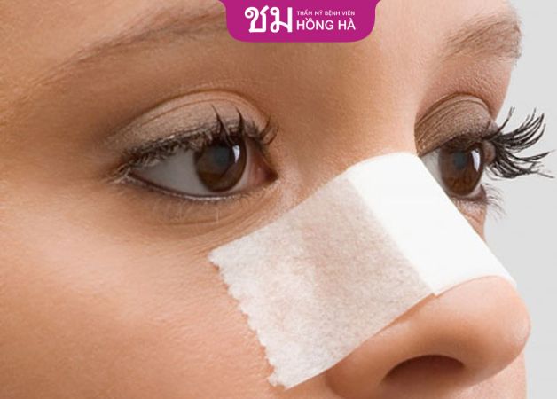 Nâng xương chính mũi với trường hợp mũi gãy kín