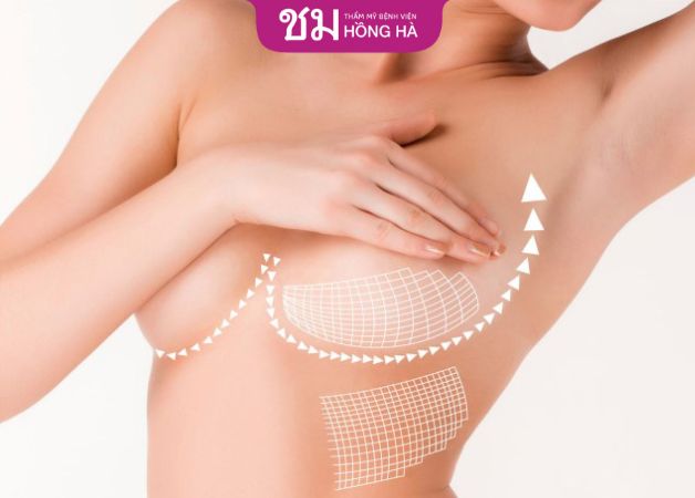 Phẫu thuật nâng ngực sau sinh khắc phục chảy xệ