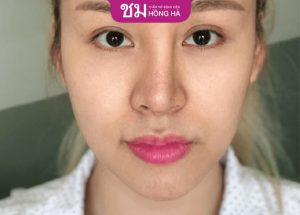 Sửa lại mũi đã nâng có đau không – Robert Nguyễn giải đáp