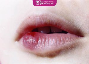 Sửa sẹo môi lâu năm – Tái sinh môi đẹp nhanh chóng hiệu quả