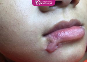 Sửa sẹo môi hết bao nhiêu tiền – 4 yếu tố ảnh hưởng tới chi phí