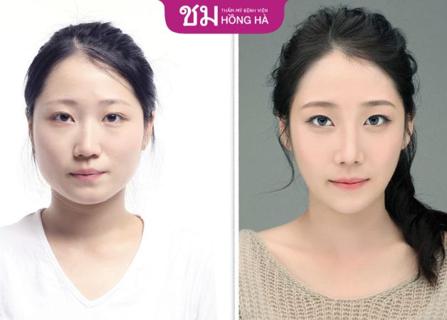 Lột xác với gương mặt chuẩn gọt hàm Thái Lan V Line chuẩn xu hướng