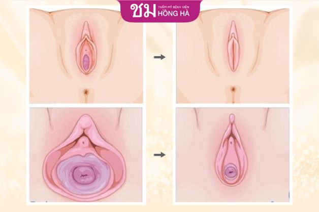 Ghi nhớ những lưu ý khi thẩm mỹ tạo hình vùng kín