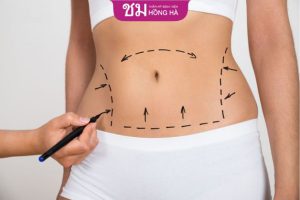 Tạo hình thành bụng là gì? Quy trình & địa chỉ phẫu thuật tốt nhất