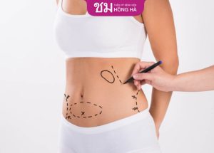 Tạo hình thành bụng mini – Khắc phục mọi khuyết điểm