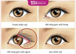 Tạo khóe mắt trong ngoài đẹp tự nhiên với phương pháp thẩm mỹ