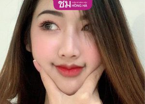 Tạo khóe môi cười: Giải pháp đem lại nụ cười đẹp, tự nhiên