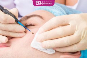 Tẩy nốt ruồi kiêng gì? 5 Thực phẩm kiêng kỵ để da mau hồi phục