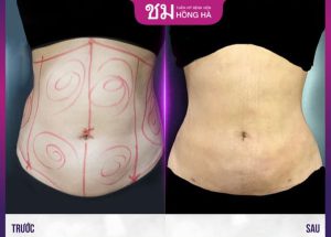 Kinh nghiệm thẩm mỹ hút mỡ bụng nhanh hồi phục, an toàn