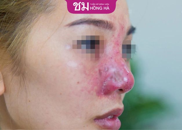 Lí do tháo sụn mũi do mũi sau nâng bị đau nhức, dẫn tới viêm nhiễm, bóng đỏ
