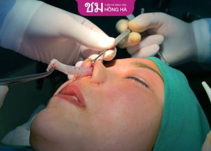 Tháo chất liệu mũi có đau không? Những yếu tố ảnh hưởng