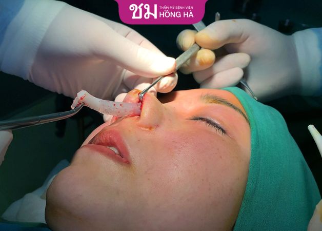 Rút chất liệu độn mũi tại Thẩm mỹ Bệnh viện Hồng Hà