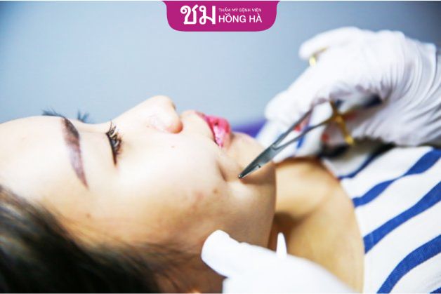 Tiến hành tháo bỏ lúm ở má