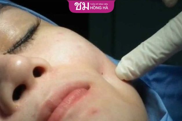 Tháo lúm đồng tiền không đau
