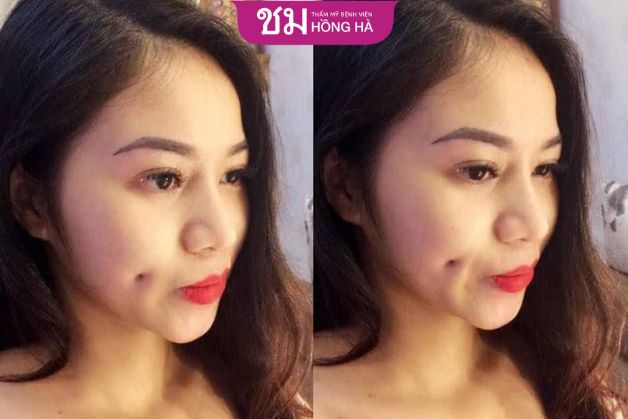 Ai nên thực hiện tháo bỏ lúm đồng tiền