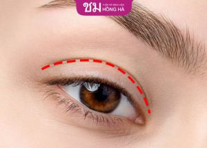 Thời gian cắt mí đẹp tự nhiên – Chăm sóc hiệu quả