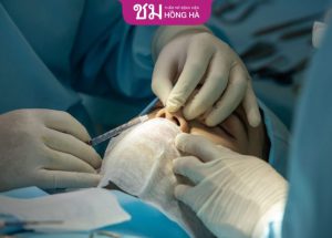 Thời gian nâng mũi bao lâu để có chiếc mũi đẹp tự nhiên?