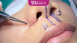 Thu cuộn cánh mũi an toàn, đẹp tự nhiên chỉ trong 30 phút