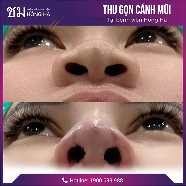 Hình ảnh thực tế sau khi phẫu thuật thẩm mỹ thu gọn hai bên mũi