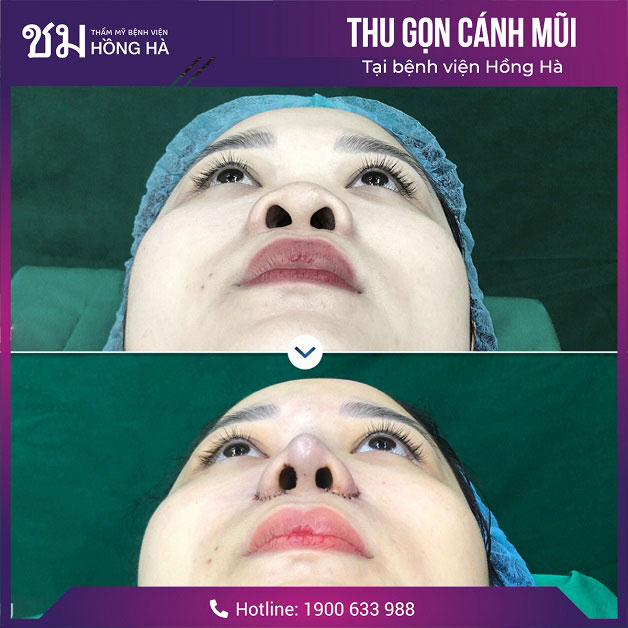 Khắc phục khuyết điểm của mũi