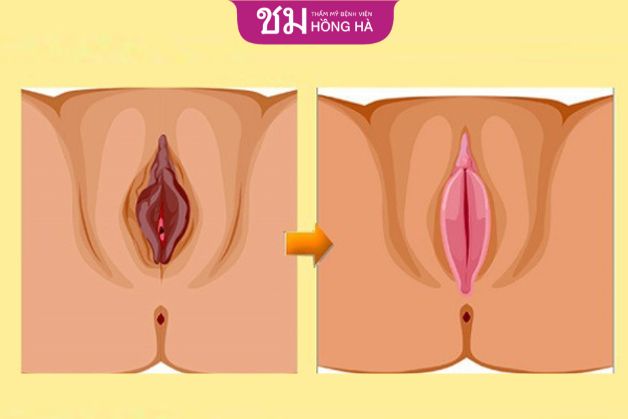 Thời gian thu gọn cô bé nhanh chóng tại thẩm mỹ viện Thái Lan tại Việt Nam chỉ mất 45 - 60 phút