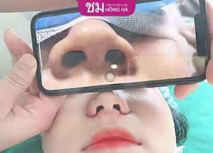 Thu nhỏ cánh mũi có ảnh hưởng gì không? Chuyên gia giải đáp