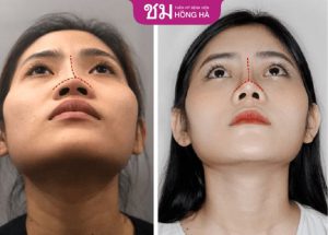 Thu nhỏ đầu mũi cánh mũi – khắc phục hiệu quả khuyết điểm